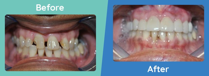 burbank-family-dental-before-after-Space Closure With Porcelain Crowns