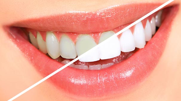 burbank family dental services Teeth Whitening and Bleaching