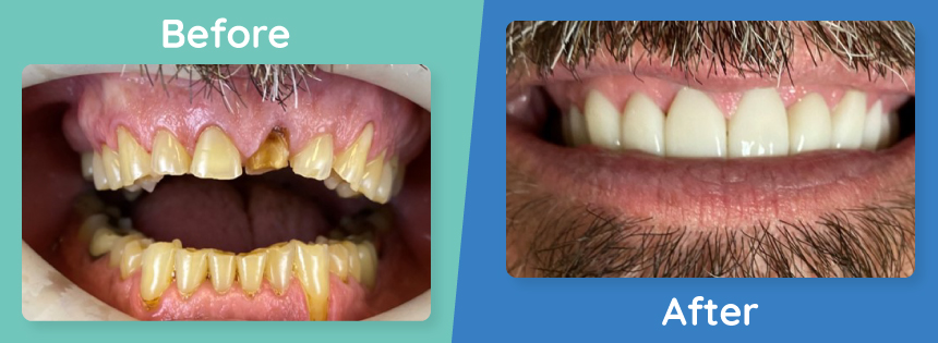 full-mouth-reconstruction-before-after-1