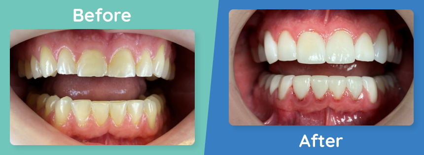full-mouth-reconstruction-before-after-3