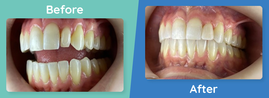 full-mouth-reconstruction-before-after-5